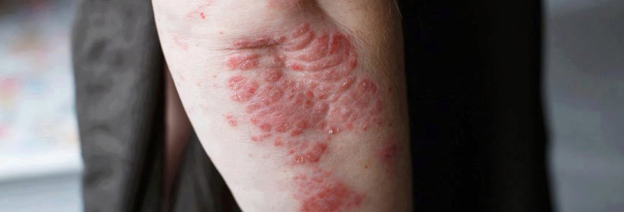 psoriasis